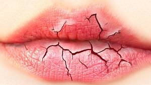 Kışın Dudak Çatlamasını Önlemek İçin Öneriler 