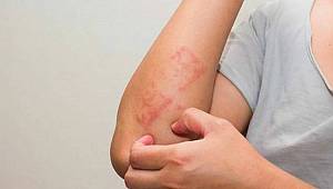 Dikkat: Hijyen eksikliği uyuza neden oluyor