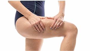 Kadınların korkulu rüyası: Selülit