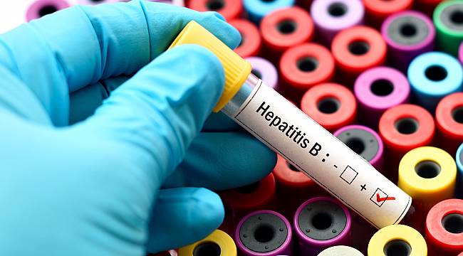 Hepatit Hastalığı, Yemek Borusu Varisi İçin Risk Oluşturuyor 