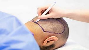 Saç Ekimi Hakkında Bilinmesi Gerekenler 